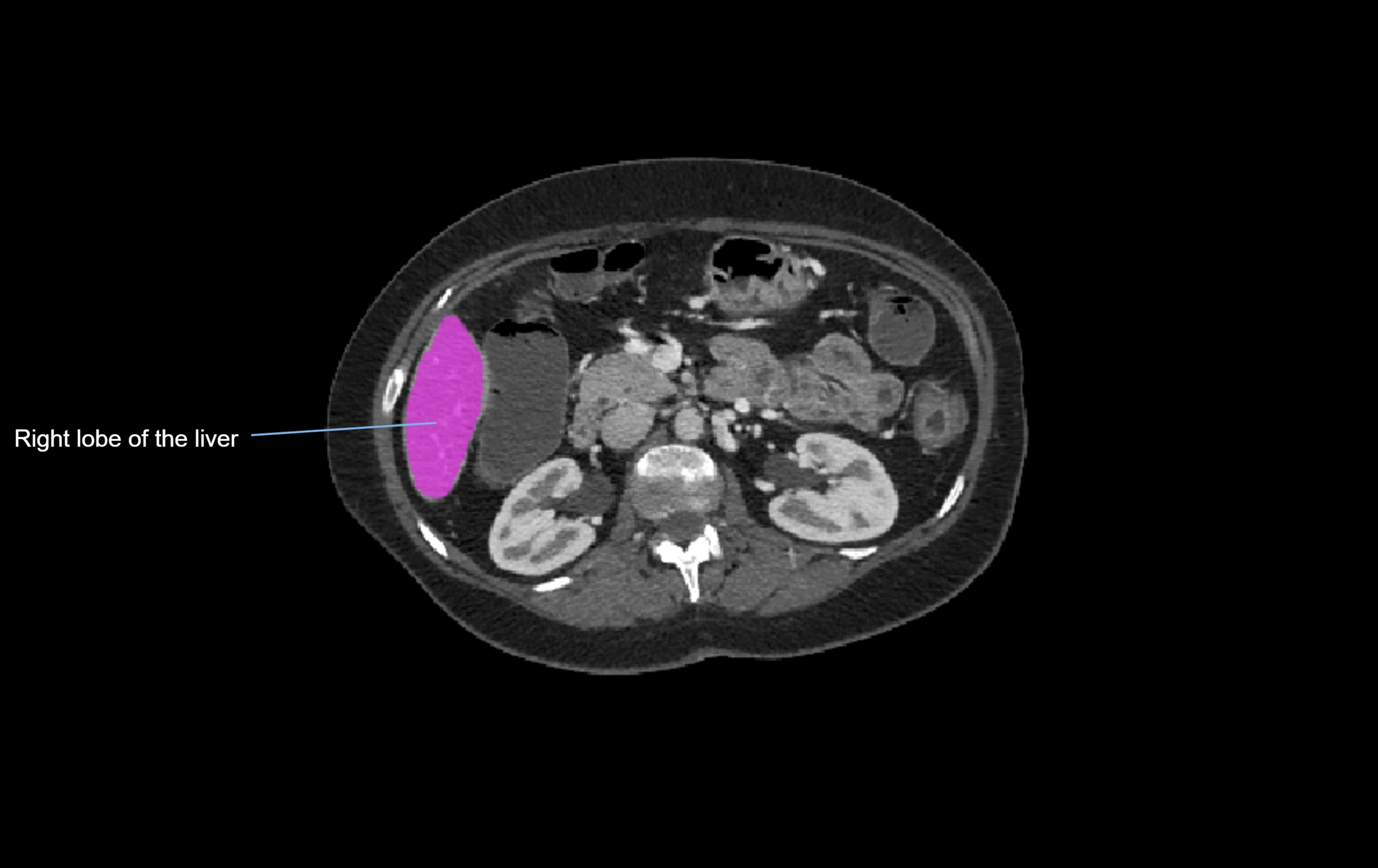 CT lliver lobes axial cross sectional anatomy labelled image -00021.webp